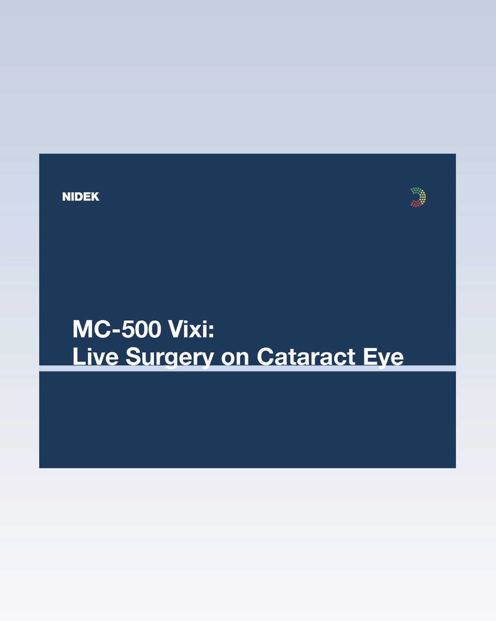 Laser Photocoagulation on Cataract Eye Live Surgery