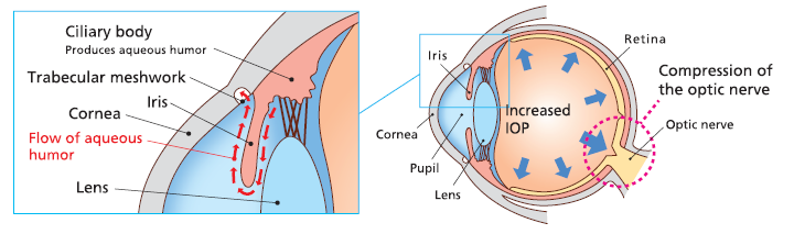 medida Interpretar Arenoso Selective Laser Trabeculoplasty (SLT) Treatment for Glaucoma - NIDEK USA