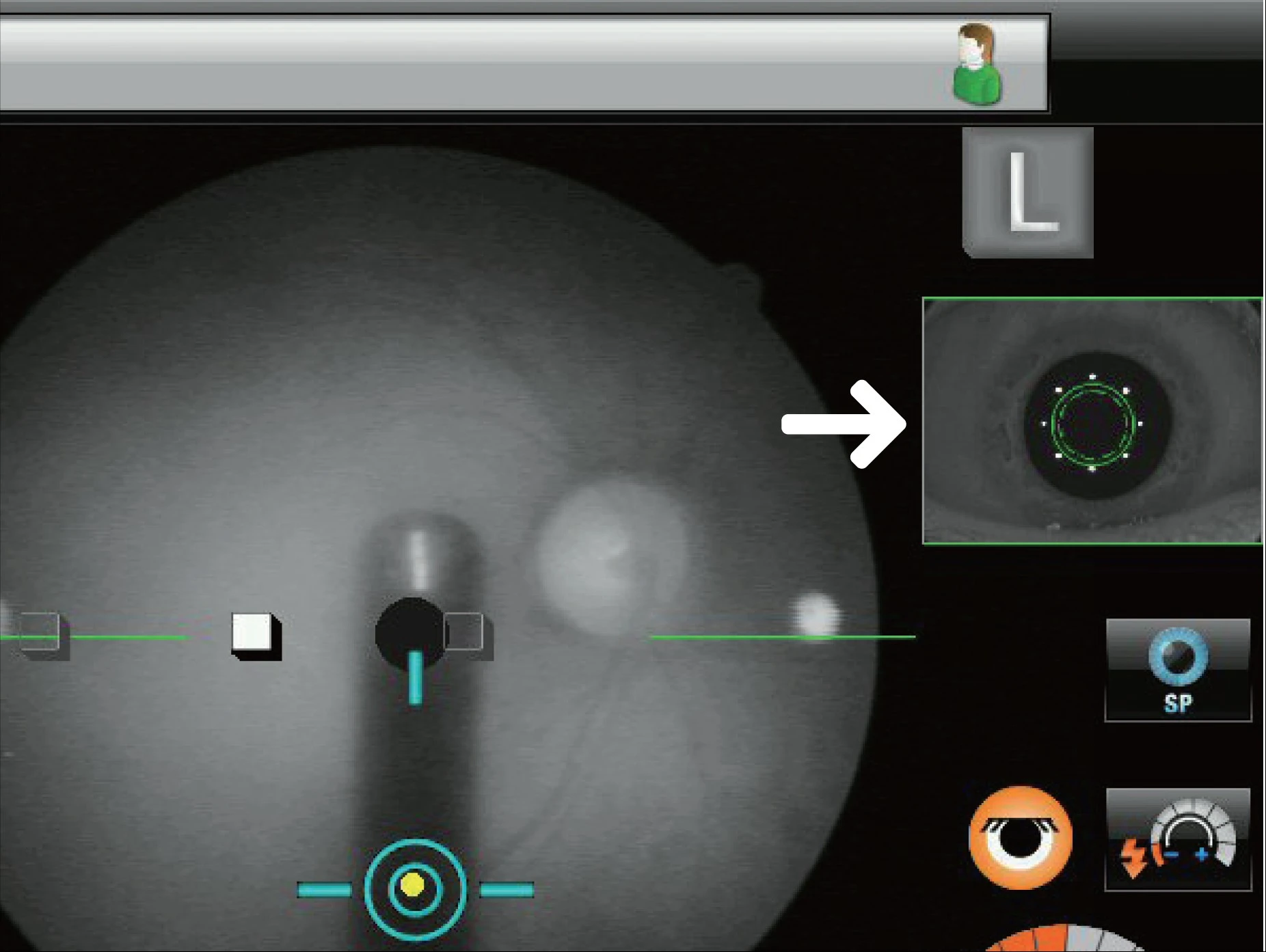 A Computer Screen Displaying A Nidek Medical Imaging Interface Focused On An Eye. The Main Image Highlights The Eye With Various Overlays, And A Smaller Inset Image At The Top Right Shows A Close-Up Of The Eye, Highlighted By An Arrow. Various Controls Are Visible On The Screen.