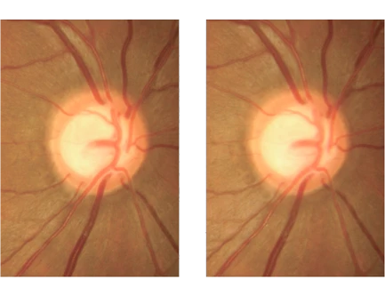 Image Of Two Side-By-Side Close-Up Eye Fundus Photographs Captured With Nidek Technology, Showing Optic Discs With Visible Blood Vessels Radiating Outwards. The Optic Discs Appear Round And Prominent With A Central Light Spot, Surrounded By A Reddish-Brick Background.