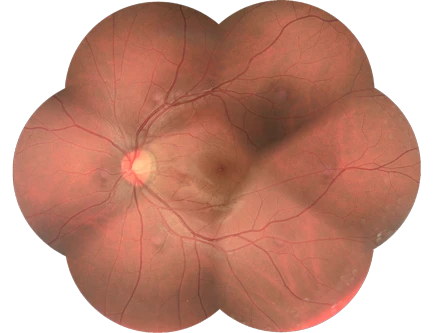 Close-Up Image Of A Human Retina Taken With A Nidek Device, Showcasing The Optic Disc, Blood Vessels, And The Overall Vascular Structure. The Retina Appears In Shades Of Pink And Red, With Intricate Vein Patterns Extending Throughout.