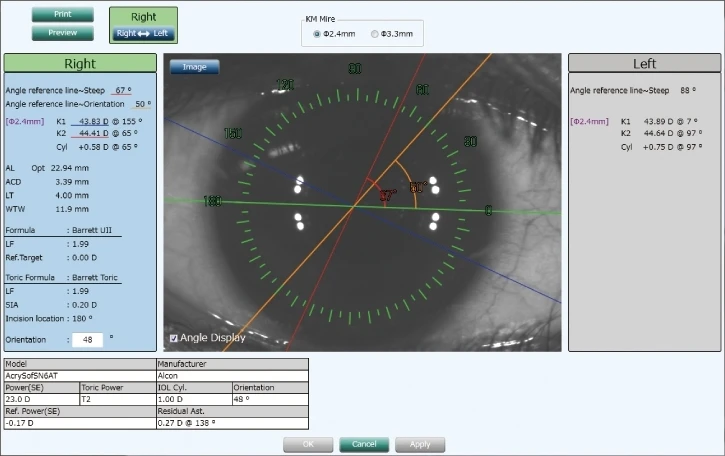 A Medical Imaging Screen Displaying An Eye With Measurement Markers And Numeric Data From Nidek. The Display Includes Information On Angle Reference, Lens Settings, And Manufacturer Details. It Also Shows Precise Values For Axis, Astigmatism, And Other Optical Parameters.