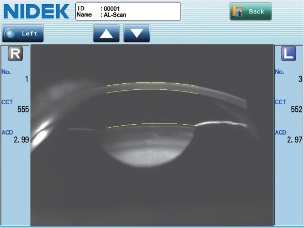 A Screenshot Of An Al-Scan From A Nidek Device. The Display Shows An Ultrasound Image Of An Eye With Various Measurements And Numerical Values On The Sides, Including Cct And Acd. Navigation Buttons Are At The Top, Labeled &Quot;Left&Quot; And &Quot;Back.