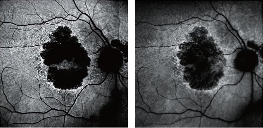 Black-And-White Medical Images Of The Retina, Captured Using Nidek Technology, Show Dark, Irregularly Shaped Areas And Branching Blood Vessels. The Left Panel Displays A More Pronounced Dark Area Compared To The Right, Which Has Discernible Details Within The Dark Region.