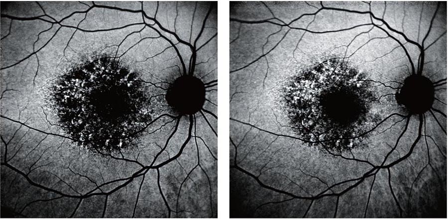Black And White Medical Image Shows Two Close-Up Views Of The Retina With Visible Blood Vessels. Both Retinas Display Dark, Irregularly Shaped Central Lesions Surrounded By Smaller Spots, Suggesting A Form Of Retinal Degeneration Or Pathology, As Captured Using Nidek Imaging Technology.