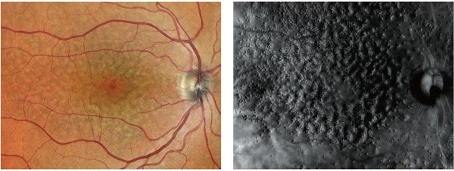 Side-By-Side Comparison Of A Human Retina Image Using Nidek Technology. The Left Image Shows A Color Photograph Of The Retina, Revealing Blood Vessels And The Optic Nerve. The Right Image Is A Grayscale Version, Highlighting The Texture And Details Of The Retina.