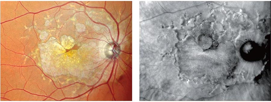 The Image Displays Two Views Of A Diseased Eye Retina, One In Color And The Other In Black And White. Both Images Highlight The Damage And Abnormalities In The Retinal Tissue, With Visible White, Yellowish Lesions, And Blood Vessels Converging At The Optic Disc. This Analysis Was Performed Using Nidek Equipment.