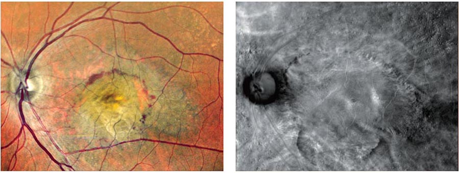 Two Images Of The Eye'S Retina. The Left Image, Captured Using A Nidek Device, Shows A Colored View With Visible Blood Vessels And A Yellowish Lesion At The Center. The Right Image Is Black And White, Highlighting The Same Lesion As A Lighter Area In The Middle.