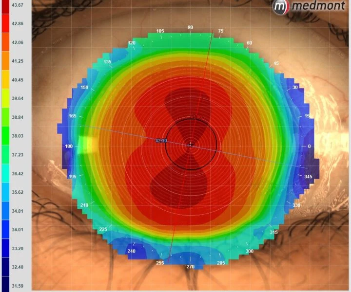 A Topographic Map Of A Human Eye, Displaying Corneal Measurements In A Concentric Pattern. The Central Area Is Red, Indicating Higher Elevations, Surrounded By Orange, Yellow, Green, Blue, And Purple For Decreasing Elevations. Medmont And Nidek Logos Are Visible.