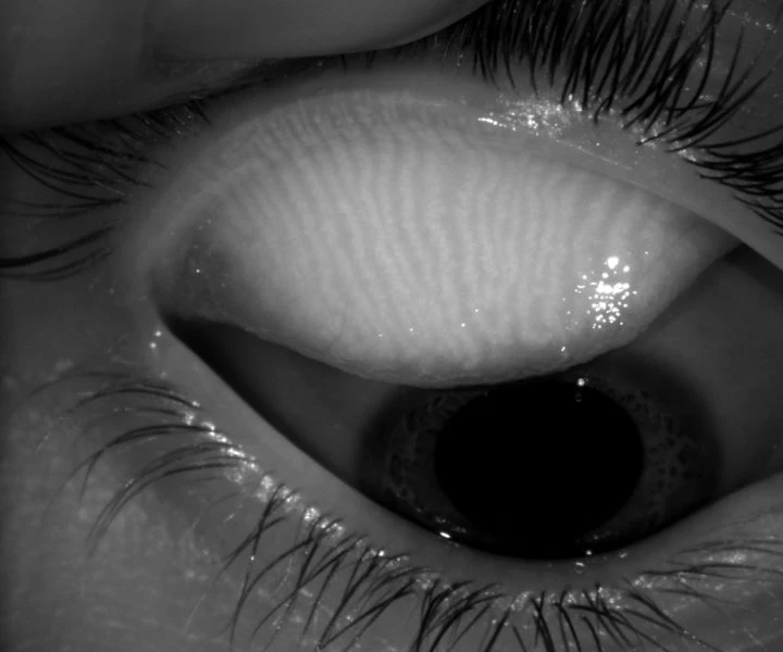 A Close-Up Black-And-White Image Of A Human Eye Taken With A Nidek Camera. The Upper Eyelid Is Being Lifted, Revealing The Textured Surface Of The Inner Eyelid. The Eyelashes Are Visible, And The Pupil Appears Dilated. The Image Has High Contrast And Detailed Focus On The Eye Structure.