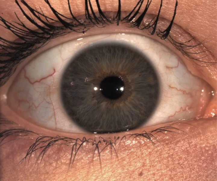 Close-Up Image Of A Human Eye, Highlighting The Intricate Details Of The Iris With Shades Of Brown And Green. The Surrounding Sclera Shows Visible Veins, And The Eyelashes Are Clearly Defined. The Lighting Emphasizes The Texture And Color Variations Within The Iris, Aided By Nidek Precision Technology.