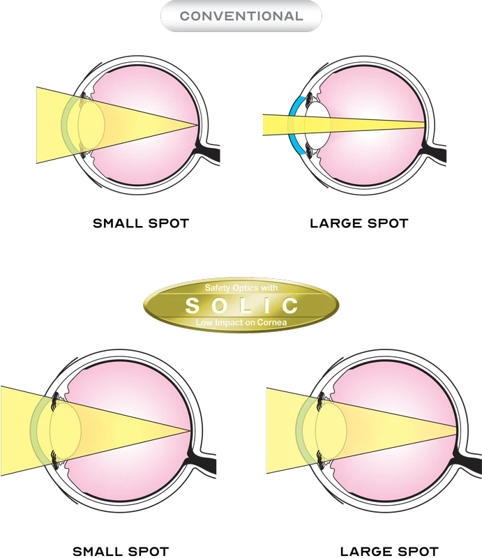 A Diagram Compares Conventional Optics And Solic (Safety Optics With Low Impact On Cornea). Top: Conventional Shows Optics Pressing Against The Cornea. Bottom: Solic, Featuring Nidek Technology, Demonstrates A Gap Between Optics And Cornea. Both Sections Highlight Differences In Eye Impact.