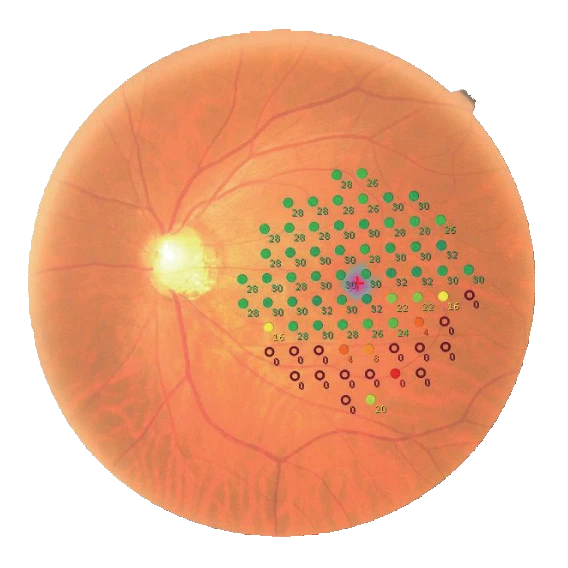 An Image Of A Retina With A Grid Overlay From Nidek, Containing Numbers. The Grid, Comprising Various Colors, Is Centered On The Retina And The Optic Nerve Is Visible On The Left. The Numbers Seem To Indicate Measurements Or Observations At Different Locations On The Retina.