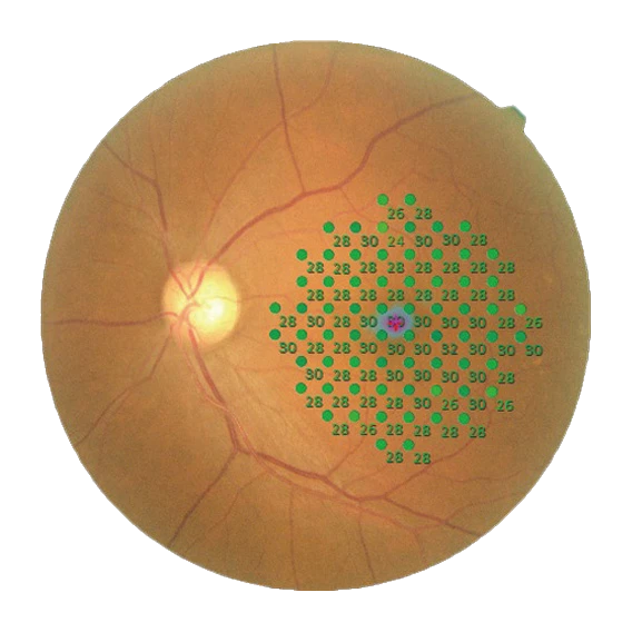 An Image Of The Retina From A Nidek Device Shows A Dense Grid Of Green And Blue Dots With Numbers, Likely Indicating Points Of Measurement Or Assessment In A Visual Field Test. The Background Is An Orange-Brown Color With Visible Blood Vessels Branching From The Optic Disc.