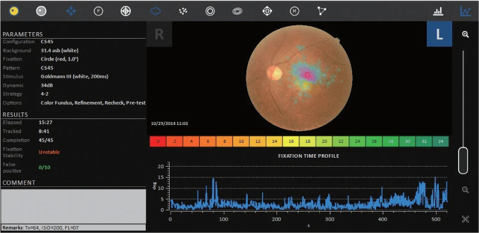 A Screenshot Of The Nidek Medical Imaging Analysis Software Displays A Retinal Image With Various Measurements And Charts. On The Right, There'S A Color-Coded Retinal Heat Map. Below, A Fixation Time Profile Graph Is Shown. Parameter Details Are Listed On The Left Side.