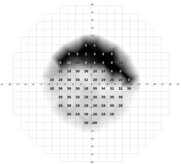 Visual Field Test Result Grid By Nidek With A Black Shaded Area At The Top, Light Gray Shades Toward The Center, And Clear At The Bottom. The Grid Displays Numerical Values Representing Sensitivity: Higher Near The Center (Up To 36) And Lower Towards The Periphery (Down To 0).