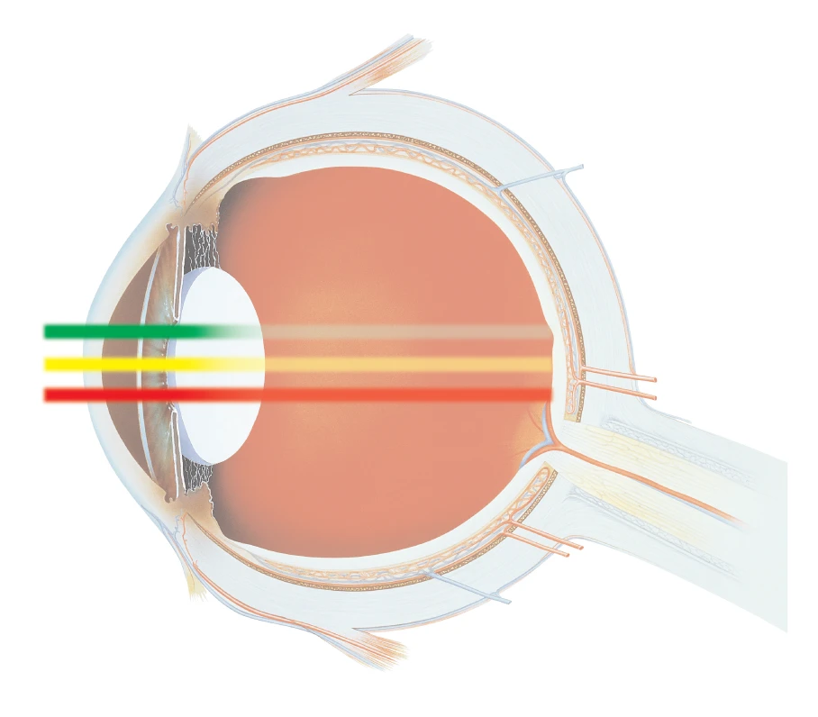 Side View Illustration Of An Eye, Focusing On How Light Enters And Gets Refracted. Three Colored Rays (Green, Yellow, And Red) Are Shown Entering The Eye, Highlighting The Path They Take Through The Cornea, Lens, And Reaching The Retina At Different Focal Points. Nidek Technology Aids This Process.