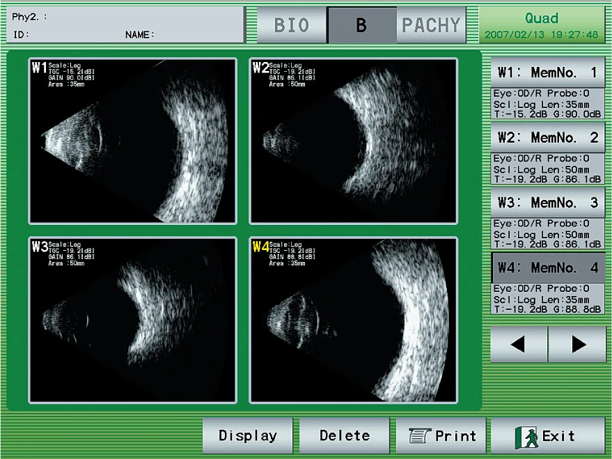 A Nidek Ophthalmic Ultrasound Scan Showing Four Different Cross-Sectional Images Of An Eye, Labeled W1, W2, W3, And W4. The Interface Includes Control Buttons Labeled Display, Delete, Print, And Exit. Measurements And Settings Are Noted Alongside The Images.