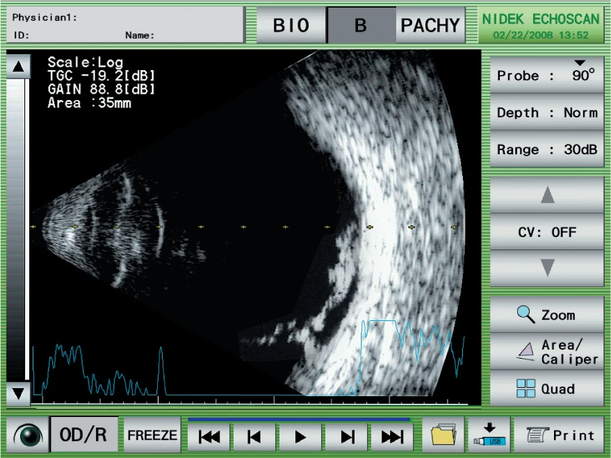 Medical Ultrasound Image Of An Eye On A Nidek Monitor. The Display Shows Various Settings Including Tgc, Gain, And Area. The Right Side Of The Screen Presents Probe Information, Depth, Range, And Other Options. There Are Control Buttons At The Bottom Of The Screen.