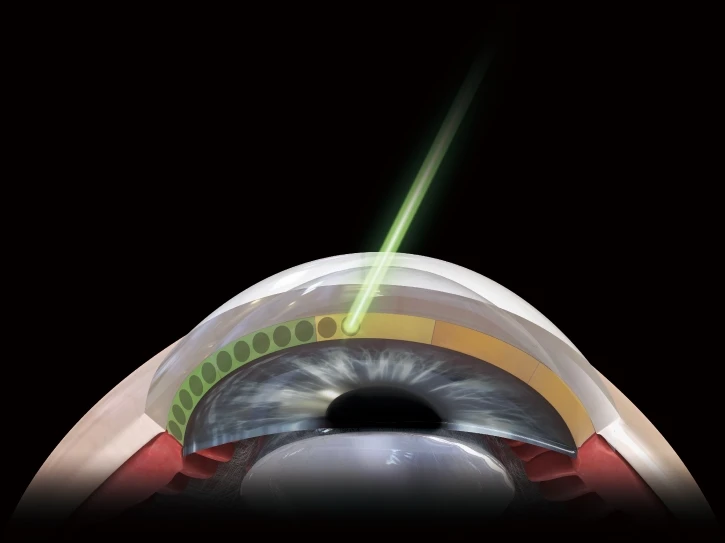 A Digital Illustration Of An Eye Undergoing A Nidek Laser Procedure. The Cross-Sectional View Shows A Laser Beam Targeting The Cornea, Creating Small Circular Incisions. The Background Is Black To Highlight The Surgical Process.