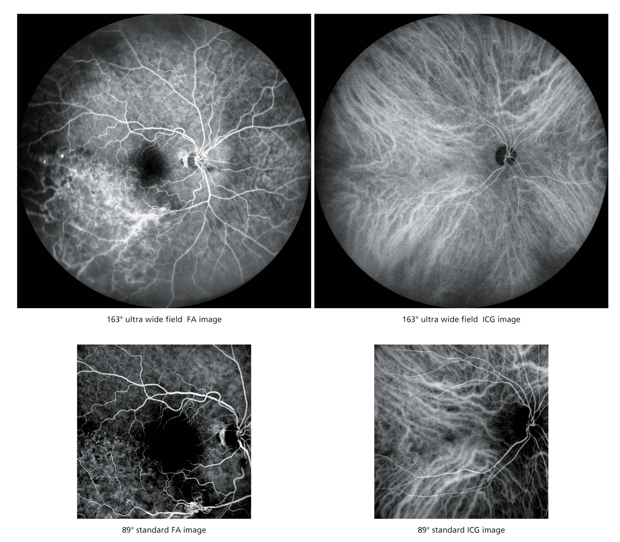 The Image Displays Four Grayscale Medical Images Showing Retinal Scans. The Top-Left And Top-Right Images Are 163° Ultra-Wide Field Fa And Icg Images From Nidek, Respectively. The Bottom-Left And Bottom-Right Images Are 89° Standard Fa And Icg Images, Respectively, Showcasing Intricate Retinal Patterns And Blood Vessels.
