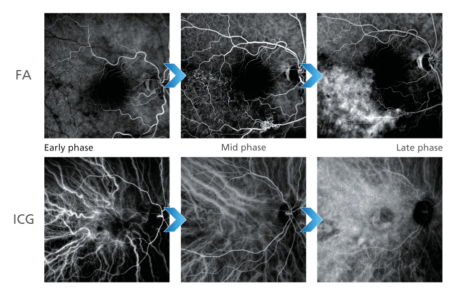 A Grid Of Six Black-And-White Medical Images Showing The Progression Of Eye Scans Over Time, Taken With Nidek Equipment. The Top Row Is Labeled &Quot;Fa&Quot; And Has Three Images: Early, Mid, And Late Phase. The Bottom Row Is Labeled &Quot;Icg&Quot; With Corresponding Early, Mid, And Late Phase Images. Blue Arrows Indicate The Sequence.