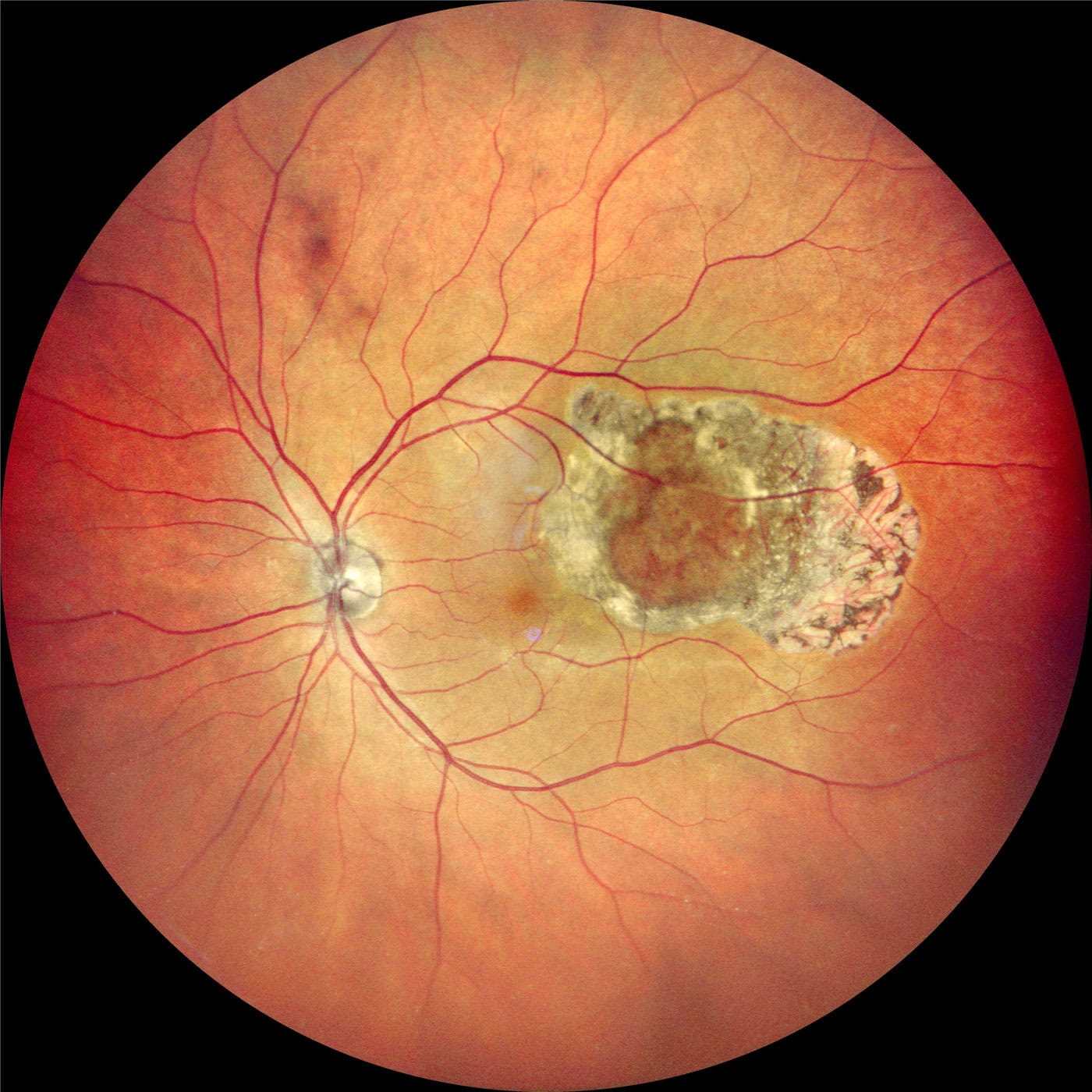 A Retinal Image Captured With A Nidek Device Shows Detailed Blood Vessels Radiating From The Optic Nerve. A Large, Irregularly Shaped Lesion Is Present Near The Center, Exhibiting Scar-Like Tissue. The Overall Color Palette Of The Retina Includes Red, Orange, And Brown Hues.