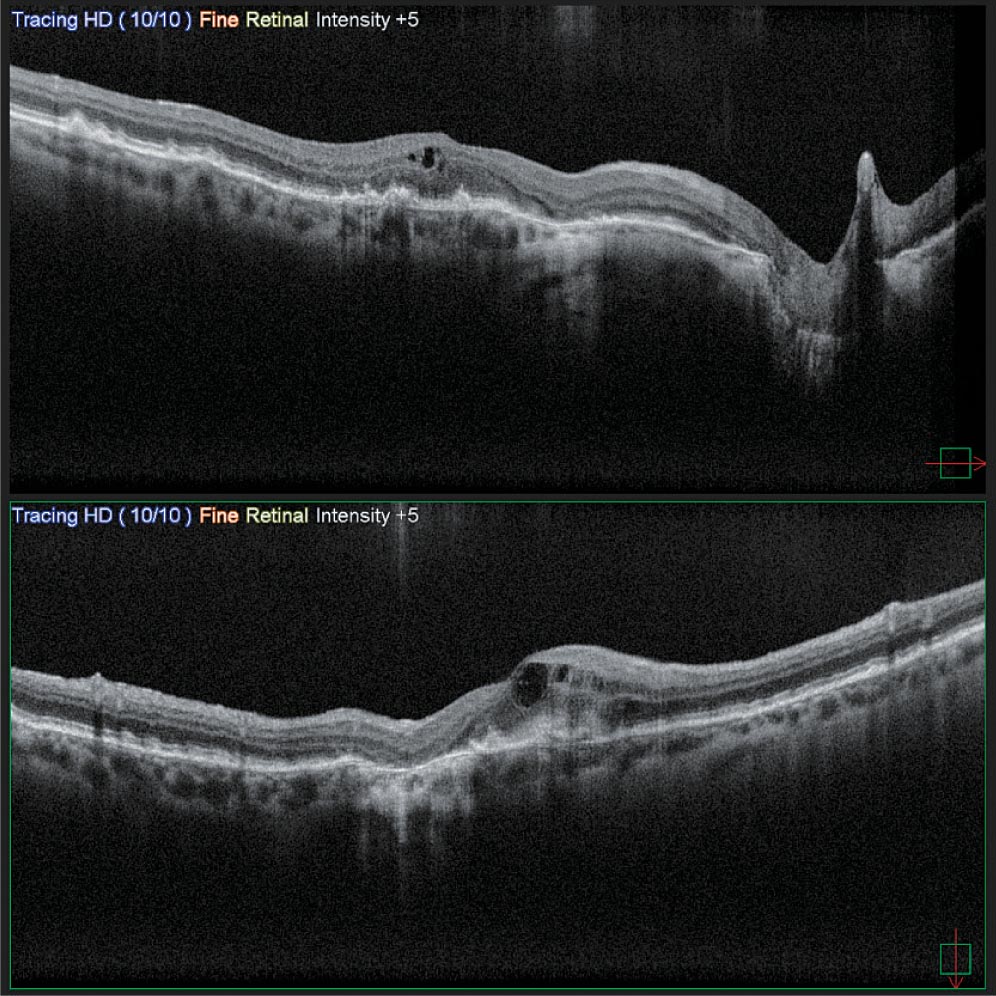 Two Retinal Scans (Oct Images) From The Nidek System, Labeled &Quot;Tracing Hd 10/10 Fine Retinal Intensity +5,&Quot; Reveal Cross-Sectional Views Of The Retina. The Top Scan Shows Abnormal Swelling And Fluid Accumulation, While The Bottom Scan Displays A Slightly Improved Condition With Reduced Swelling.