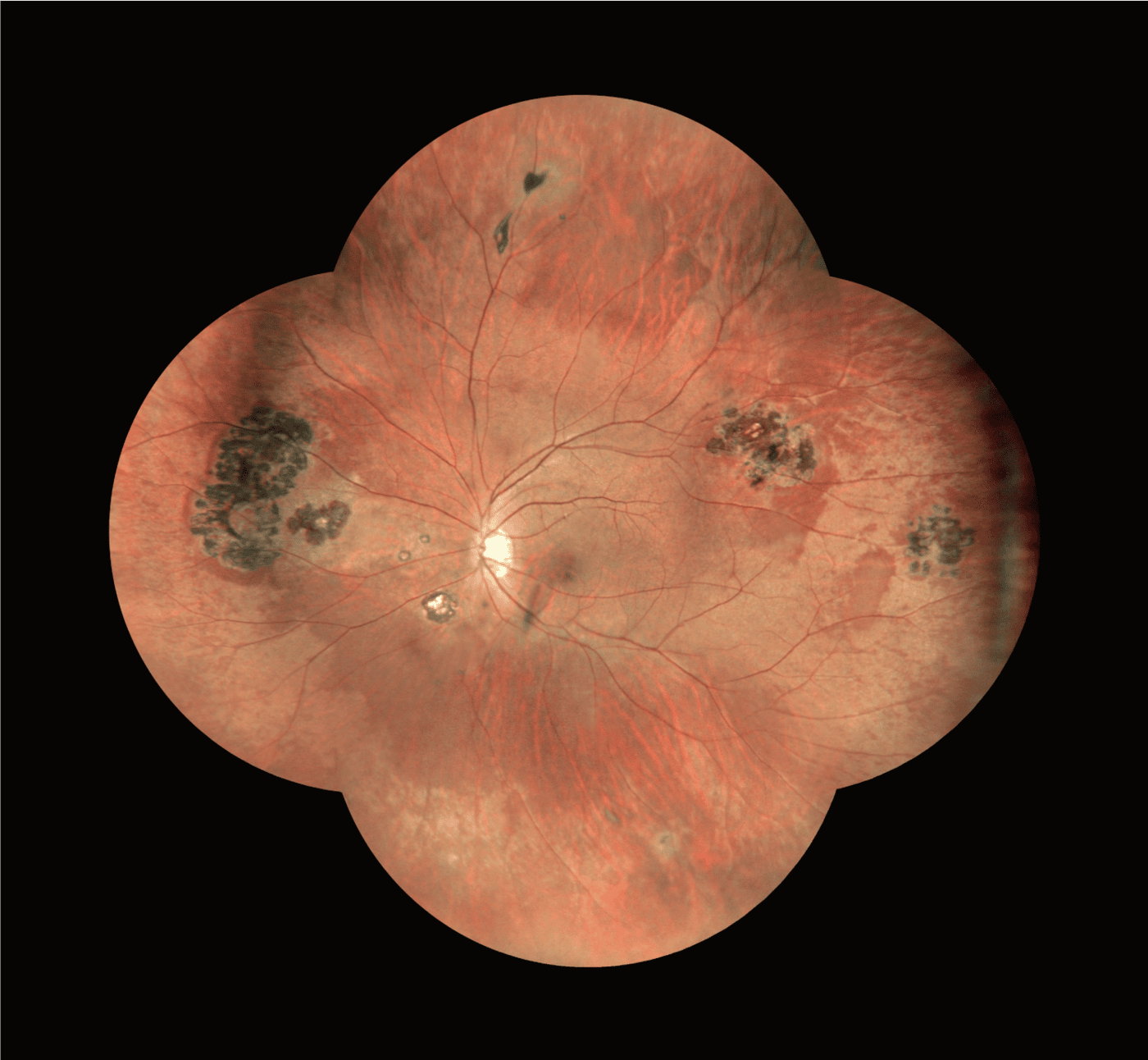 A Detailed Retinal Image Captured With Nidek Technology Shows The Optic Nerve, Blood Vessels, And Irregular Dark Patches. The Central Area Appears Pale, While The Surrounding Tissue Has Red And Brown Hues. The Image Resembles A Clover Shape, Indicating Multiple Frames Stitched Together.