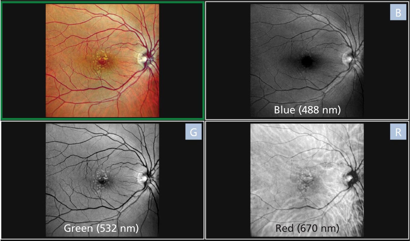 A Multi-Panel Image Displays A Human Retina Captured Using Different Wavelengths Of Light With Nidek Technology. The Top Left Is In Color, Showing Detailed Veins. The Top Right (488 Nm), Bottom Left (532 Nm), And Bottom Right (670 Nm) Show The Retina In Grayscale With Increasing Brightness And Detail.