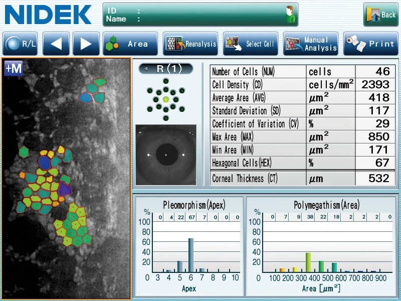 A Medical Diagnostic Screen From Nidek Showcases An Eye Scan With Areas Marked In Different Colors. Data Includes Cell Count, Density, And Other Metrics. Two Graphs Labeled &Quot;Pleomorphism (Apex)&Quot; And &Quot;Polymegethism (Apex)&Quot; Display Cell Distribution And Variation. Nidek'S Intuitive Buttons Are Visible At The Top.