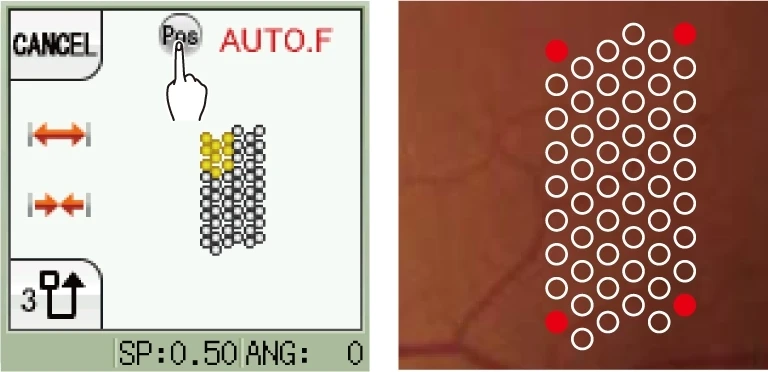 A Visual Display Shows An Interface For A Nidek Procedure. The Left Side Displays A &Quot;Cancel&Quot; Option, A &Quot;Pas&Quot; Button Being Pressed, And &Quot;Auto.f&Quot; In Red. Below Is A Grid Of Circles With Some Highlighted In Yellow. The Right Side Displays A Similar Grid Of Circles With Three Red Dots.