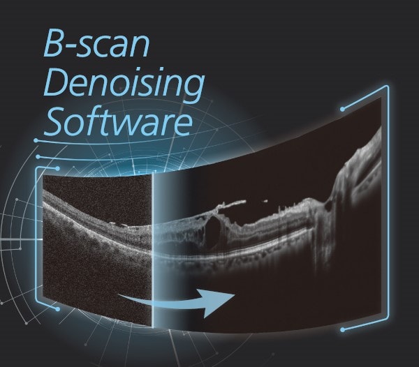 An Image Showing The Effectiveness Of B-Scan Denoising Software. It Features A Side-By-Side Comparison Of A Noisy B-Scan Image And A Denoised Version, Emphasizing The Improvement In Image Quality With The Software. An Arrow Points From The Noisy To The Denoised Image.