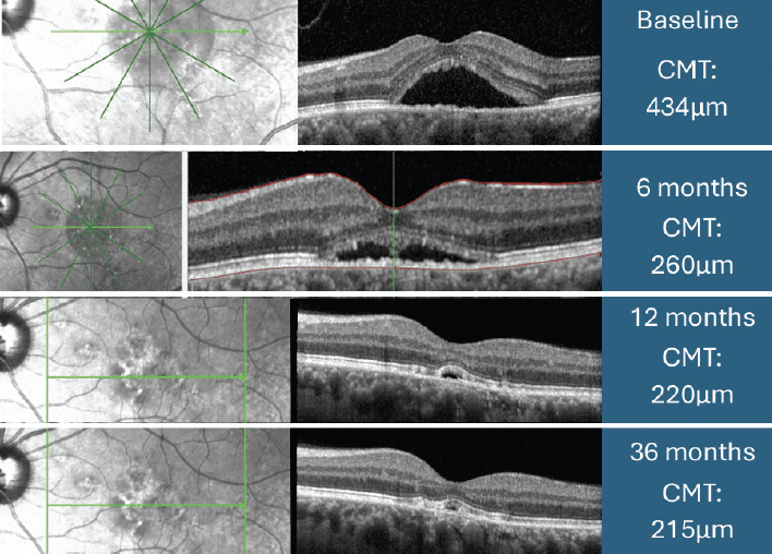 Figure 2. The Follow-Up Examinations Of Fundus Photos And Oct Images Of A Patient.