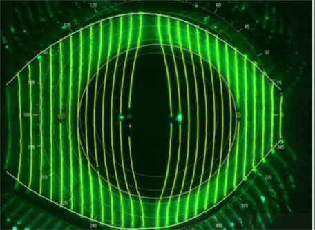 Single Capture From Vantage Scleral Topographer