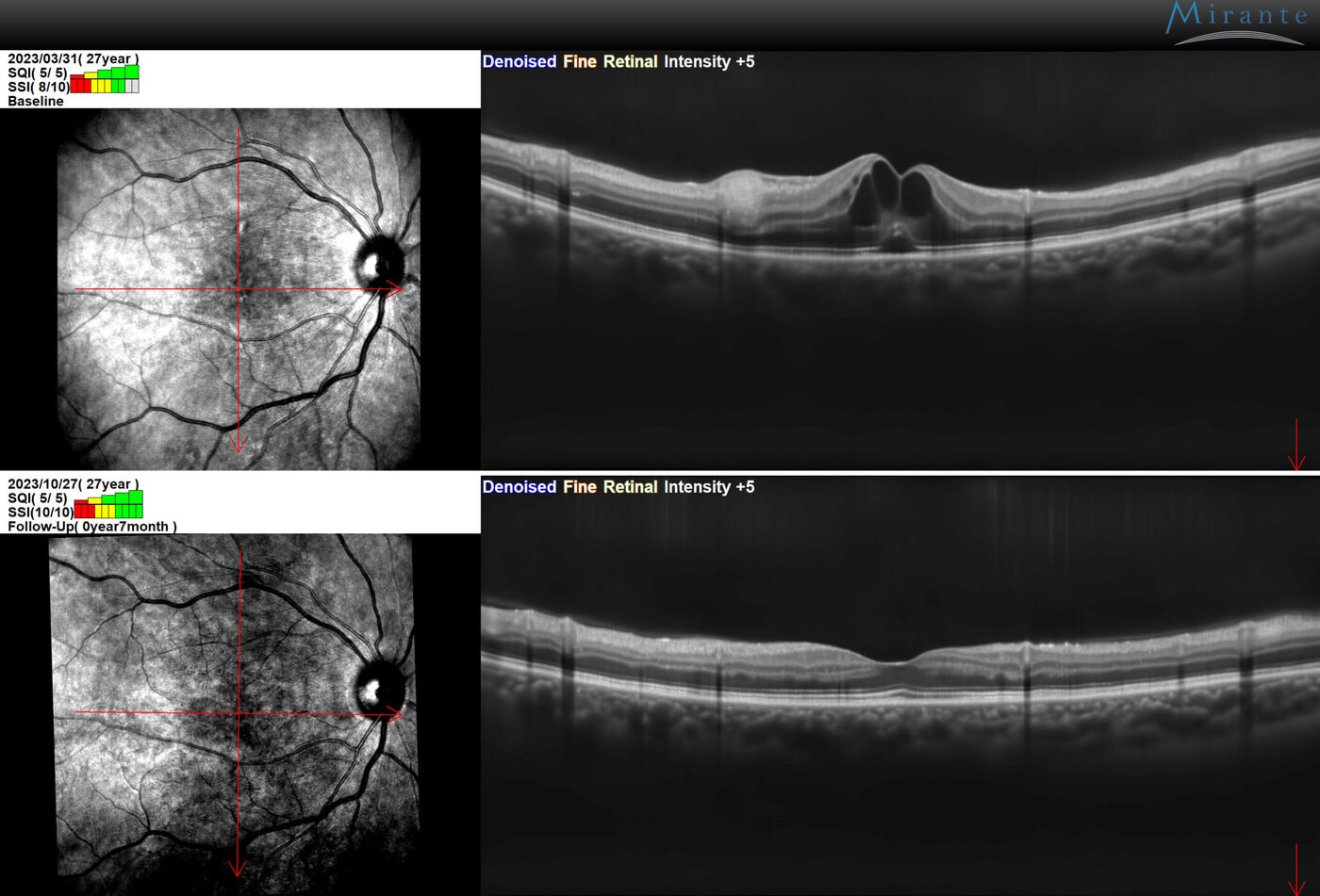 Two Pairs Of Retinal Scan Images: The Top Pair Shows Retinal Swelling Or Fluid Accumulation In The Center, While The Bottom Pair Shows Improved, Flatter Retinal Layers After Seven Months Of Follow-Up.